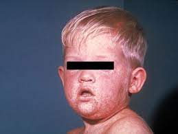 La rougeole est une infection causée par un virus qui atteint les voies respiratoires. Rougeole Gouvernement Du Quebec