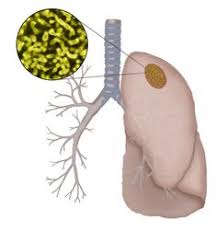 Abpa can affect healthy people but it is most common in people with asthma or cystic fibrosis. 9 Aspergillus Aspergillosis Ideas Fungi Lung Disease Lung Infection
