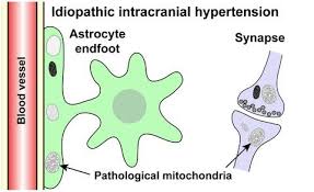 It causes signs and symptoms of a brain tumor. Increased Occurrence Of Pathological Mitochondria In Astrocytic Perivascular Endfoot Processes And Neurons Of Idiopathic Intracranial Hypertension Journal Of Neuroscience Research X Mol