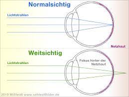 Weitsichtigkeit Nahsicht Probleme Einfach Erklart
