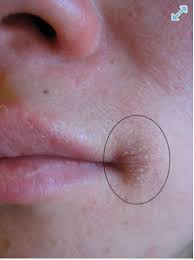 Image result for Angular Stomatitis