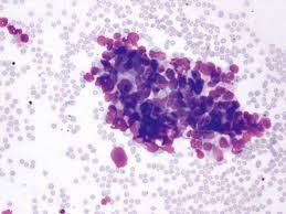 Bone marrow — the soft, spongy tissue inside the large bones in the body — can be affected by a variety of blood disorders, blood cancers and other diseases. Scientific Image Gallery
