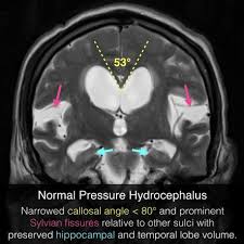 Image result for Normal Pressure Hydrocephalus