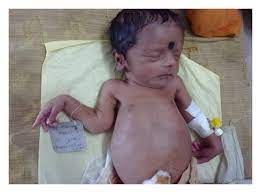 Maybe you would like to learn more about one of these? Symptomatic Early Congenital Syphilis A Common But Forgotten Disease