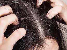 Depending on the type of fungi responsible for. Myth Busting Itchy Scalp And Hair Loss How Are They Related