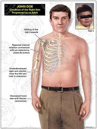 Pin On Secondary Complications