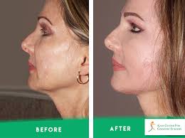 In the words of nelson mandela, it always seems not sure how genuine this is. Face Neck Before After Photos Kass Center For Cosmetic And Plastic Surgery