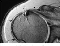 The transverse humeral ligament (brodie's ligament) forms a broad band bridging the lesser and greater tubercle of the humerus. Figure 5 From Mri Of The Rotator Interval Of The Shoulder Semantic Scholar
