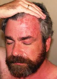 Om du kommer i kontakt med dessa sjukdomar, kontakta läkare omedelbart. Diarre Pa Ansiktet Orsaker Behandling Forebyggande