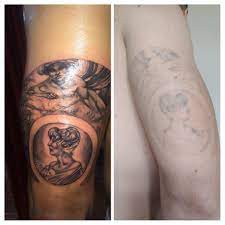 3 Years Of Progress Tattooremoval