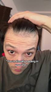 Transformed with a Hair Transplant: Say Goodbye to Balding