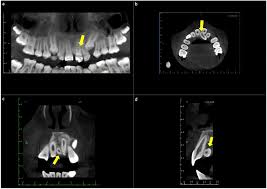Charting Supernumerary Teeth | Dentrix Ascend