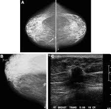 Image result for Mammogram Interpretation