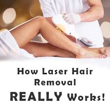 Then you will get permanent treatment. How Laser Hair Removal Really Works