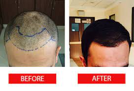 How Long Does A Hair Transplant Take Although The Hair Transplant Was First Popularised In The 1950 Hair Transplant Hair Transplant Cost Best Hair Transplant