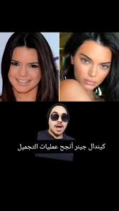 ‫عمليات تجميل كيندال جينر كيندال جينر قبل و بعد #كيندال_جينر #الكاردشيان  #عمليات_تجميل #فيلر #بوتوكس #عملية_الانف #itslokmanes #kendalljenner‬‎