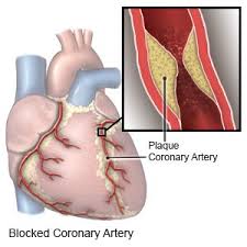 How do i know if i have clogged arteries. Coronary Artery Disease In Women What You Need To Know