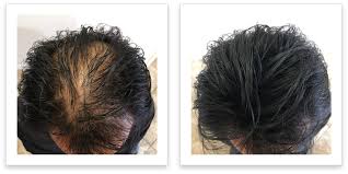 Select from premium thinning hair woman of the highest quality. Buy Febron Hair Fibers For Thinning Hair Black Giant 30g For Women Men Hair Loss Concealer Hair Powder Volumizing Based 100 Undetectable Natural Bald Spots Filler Online In Vietnam B07hctkhh8