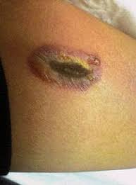 It's commonly seen with pressure ulcer wounds (bedsores). Eschar Wiktionary
