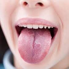 Those Red Patches On Your Tongue Are Nothing To Be Alarmed About South Lyon Dental Care Center