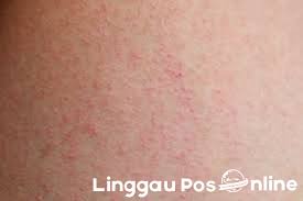 Moms juga dapat menggunakan ibuprofen jika dia berusia di atas 6 bulan. Kulit Gatal Dan Bintik Bintik Merah Awas Gejala Corona Linggau Pos Online