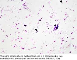 Pathology Outlines Schistosomiasis Bilharziasis