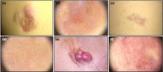 Image result for Dermatofibrosarcoma Protuberans