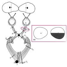 Image result for Visual Field Deficit
