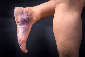 Image result for Pigment stains on the shin