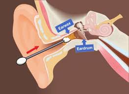 It might seem harmless to take your little pinkie finger and dig in. This Why You Should Never Dig Your Ear With A Cotton Bud Dr Gan Eng Cern