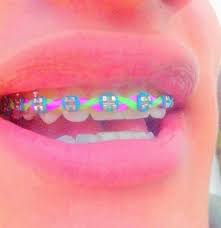 Son iguales que los metálicos solo que están recubiertos por una fina capa de oro. Estos Me Encantaron 3 Ligas Color Fosfo Ligas Para Brackets Brackets Dientes Con Brackets