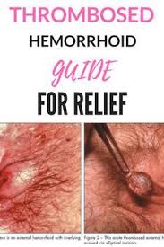 The quickest and most effective thrombosed hemorrhoid treatment is removing the blood clot. Thrombosed Hemorrhoids 101 A Guide To Thrombosed Hemorrhoids Relief Thrombosed Hemorrhoid Home Remedies For Hemorrhoids Hemorrhoid Relief