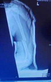 Jilbab asyik cipokan sambil cegukan. Cik Lily Patah Tangan Accident Naik Motor Tulang Humerus