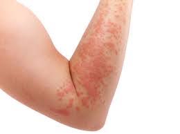 The purpose of this website is to promote my personal experiences about my nickel food allergy, nickel allergy and eczema. Nickel Allergy Ireland Pdf Ppt Case Reports Symptoms Treatment