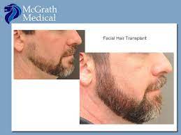 Facial hair implants can completely change your look and complement your natural features. Pin On Facial Hair Transplant Before And After Photos