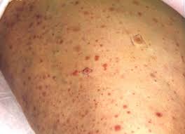 Some of the causes include: Petechiae Definition Petechial Rash Causes Diagnosis Treatment