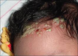 Image result for sores on the head in children