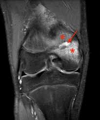 Image result for Osteomyelitis Bone Scan