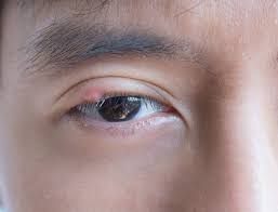 눈병과 다래끼를 한번에 치료할 수 있는 방법