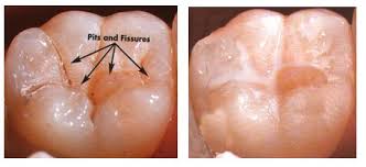 Should you be sealing your wood before you stain, or after? Pit And Fissure Sealants Sri Vinayaga Dental Clinic