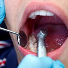 We have ensured our wisdom teeth extraction costs are extremely competitive when compared to other top rated nearby london dentists. Tooth Extraction Healing Time Cost Removal Process Electric Teeth