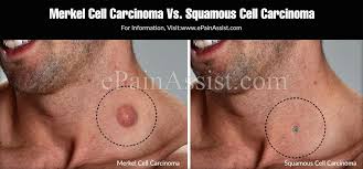 They are abundant in highly sensitive skin like that of the fingertips in humans. Merkel Cell Carcinoma Vs Squamous Cell Carcinoma
