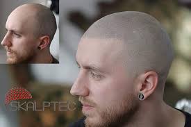 Scalp micropigmentation helps restore confidence in men & women who are struggling with thinning hair. Scalp Micropigmentation Aftercare Skalptec Ltd Smp Uk