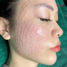 U hạt sau tiêm Meso là gì? Tất tần tật kiến thức về tiêm Mesotherapy