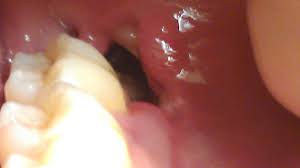 Maybe you would like to learn more about one of these? Dry Socket Vs Normal Socket Pictures Symptoms And Healing Time