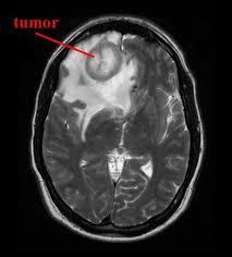 What Does Lung With Inflammation Look Like In A Ct Scan From The Top Google Search Radiography Cat Scan Ct Scan