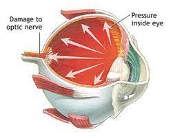 Eye Pressure (Ocular Hypertension) · Nyc Eye Doctor · Ophthalmologist