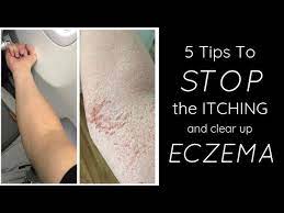 Check spelling or type a new query. Healing Eczema 5 Things I Do Each Day To Stop The Itch Youtube