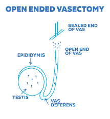 Image result for Vasectomy