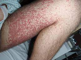 They can also arise internally and be present on various organs in the body or on the mucous membranes lining the mouth, nose, or genitals. Henoch Schonlein Purpura Causes Symptoms And Treatment